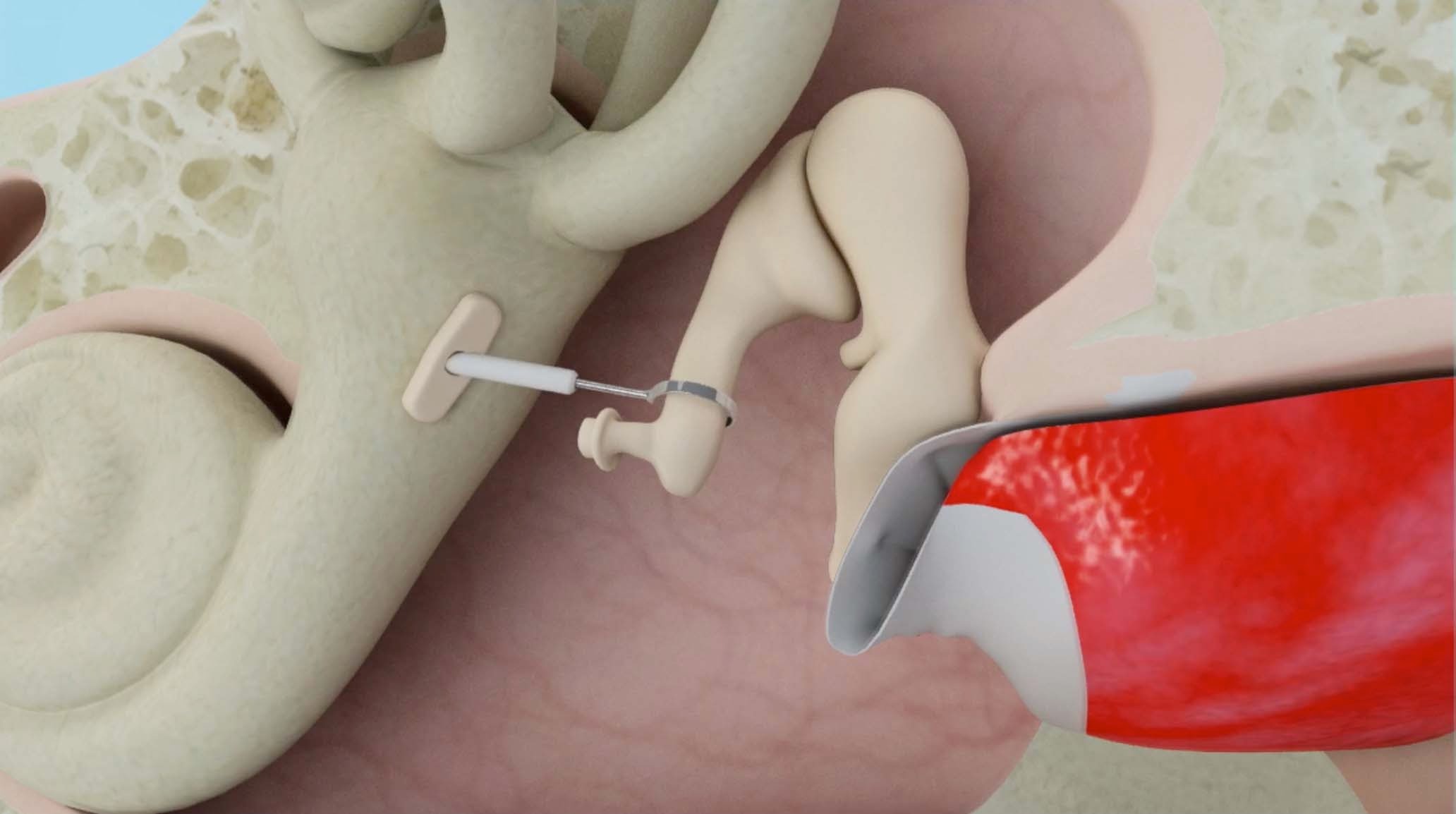 Stapedotomy