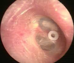 Grommet Insertion
