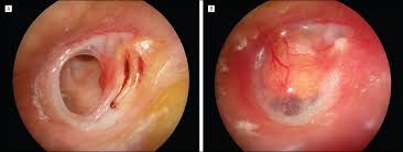 Tympanoplasty