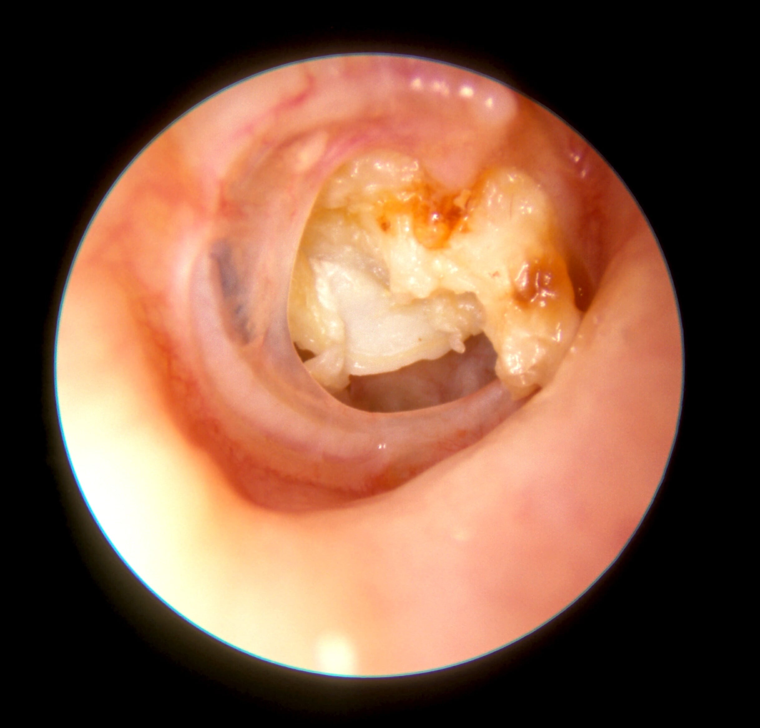 Mastoidectomy