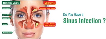 Sinusitis