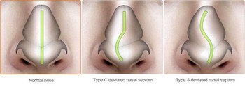 Septoplasty
