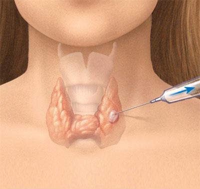 Facial Nerve Decompression