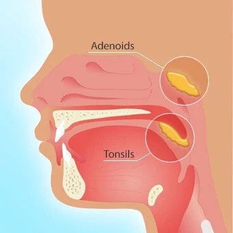 Tympanoplasty
