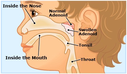 Mastoidectomy