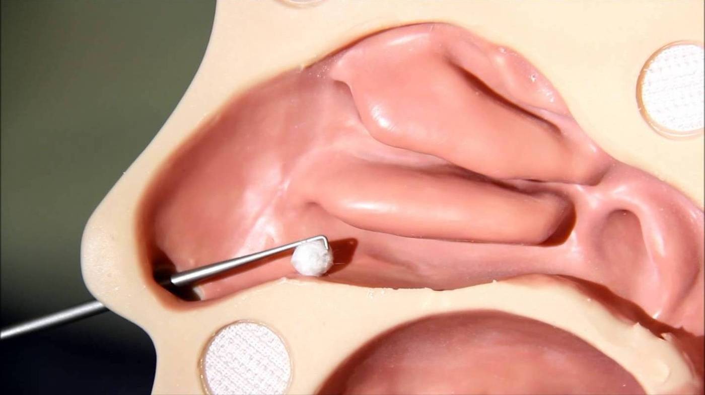 Stapedotomy